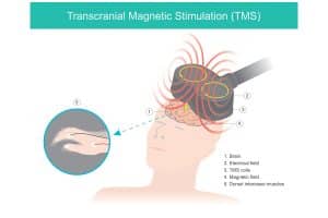 Transcranial Magnetic Stimulation Cost 