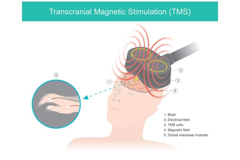 Transcranial Magnetic Stimulation Cost | South County Psychiatry